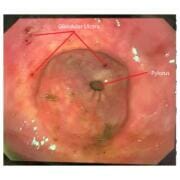 Glandular Ulcers An equine glandular ulcer